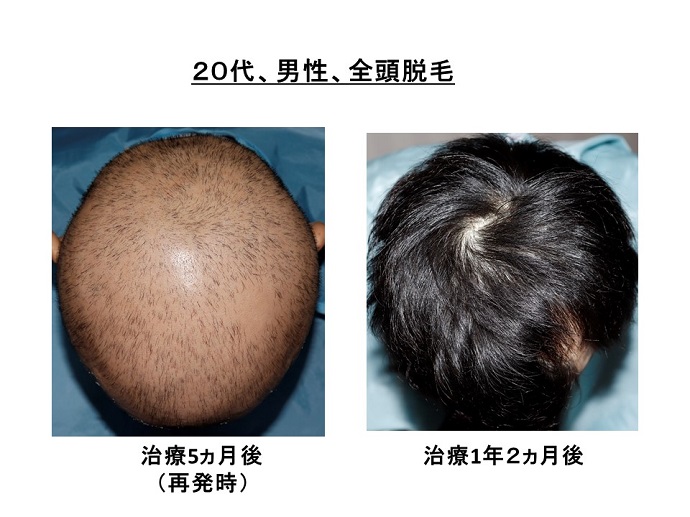 円形脱毛症　病院
